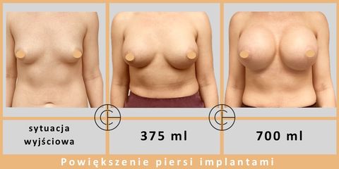 Powiększanie piersi - dr n. med. Michał Chalcarz