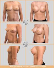 Powiększanie biustu i abdominoplastyka - dr n. med. Michał Chalcarz