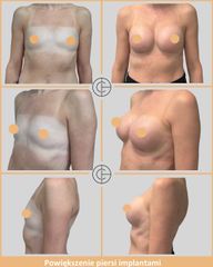 powiekszenie piersi implantami 6