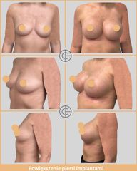 powiekszenie piersi implantami