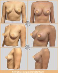 powiekszenie piersi implantami 3 czerwiec