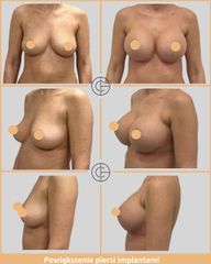 powiekszenie piersi implantami