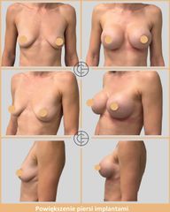 powiekszenie piersi implantami 06