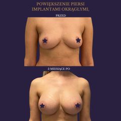 Powiększenie biustu - dr Rami Alshekh