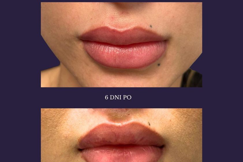 Lip Lift przed i po - 850142