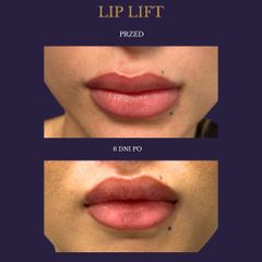 Lip lift - dr Rami Alshekh