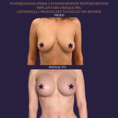 Powiększanie biustu - dr Rami Alshekh