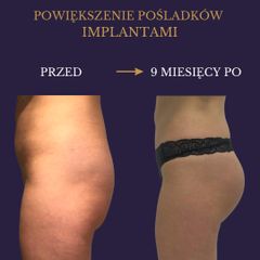 powiększenie pośladków implantami - dr Rami Alshekh