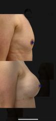 Powiększenie piersi implantami - dr Rami Alshekh
