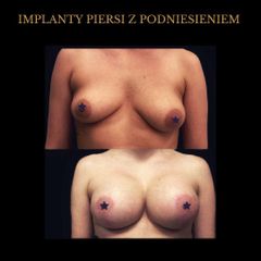 Powiększanie biustu - dr Rami Alshekh