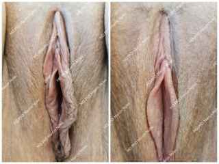 Labioplastyka - dr n. med. Marcin Nylec