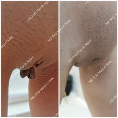 Labioplastyka - dr n. med. Marcin Nylec