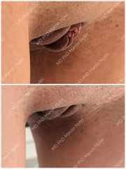 Labioplastyka dr n. med. Marcin Nylec
