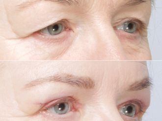 Blefaroplastyka przed i po - 879214