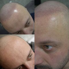 mikropigmentacja włosów głowy łysienie androgenowe męskie