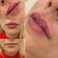 Powiększenie ust - AtenaClinic