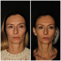 przed i po zabiegiem wolumetrii z uzyciem kwasu hialuronowego