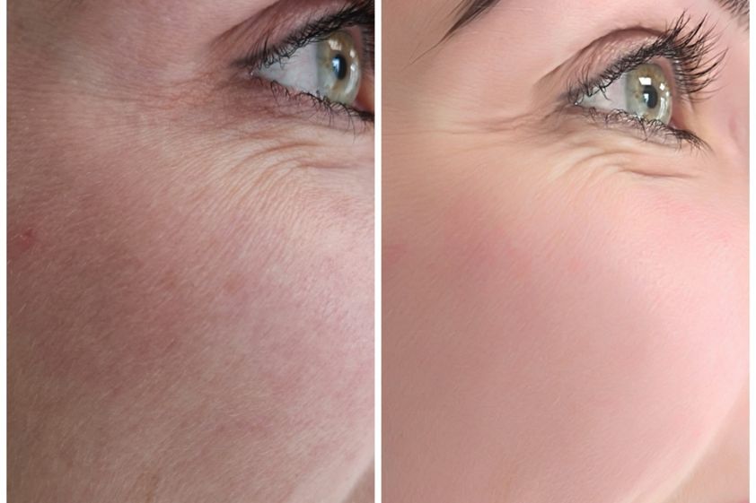 Laserowe zabiegi dermatologii estetycznej przed i po - 830731