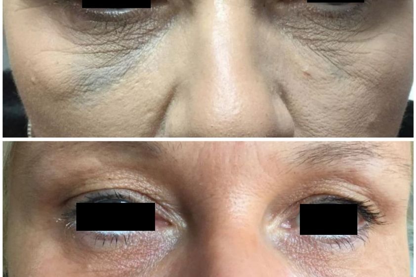 Anti-aging przed i po - 830732