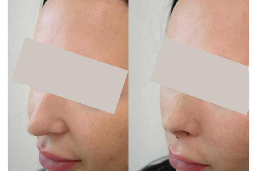 Korekta nosa kwasem hialuronowym przed i po - 842874