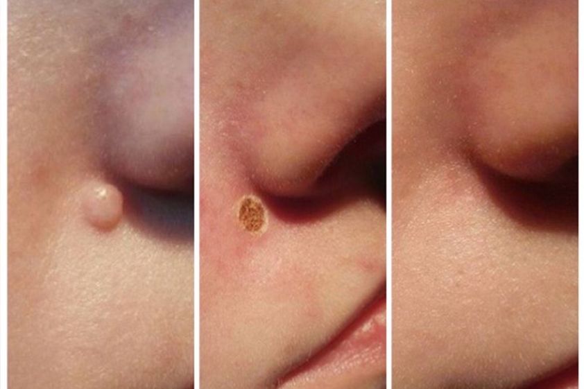 Laserowe zabiegi dermatologii estetycznej przed i po - 842893