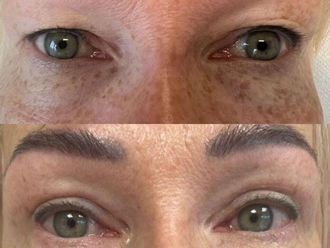 Blefaroplastyka przed i po - 877401