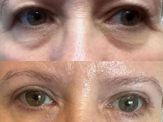 Blefaroplastyka przed i po - 877402
