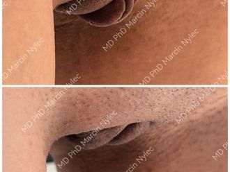 Labioplastyka przed i po - 877404