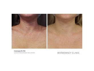 Laserowe zabiegi dermatologii estetycznej przed i po - 691885