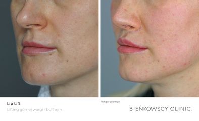 Powiększanie ust - Bieńkowscy Clinic®