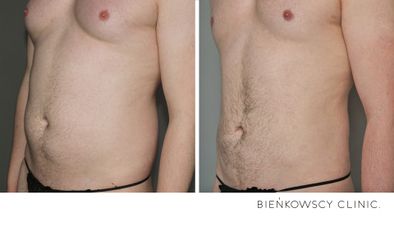 Liposukcja - Bieńkowscy Clinic®