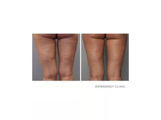 HIFU - Bieńkowscy Clinic®