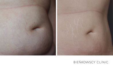 HIFU - Bieńkowscy Clinic®