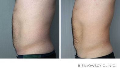 HIFU - Bieńkowscy Clinic®