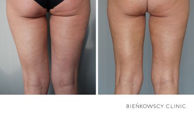 HIFU - Bieńkowscy Clinic®