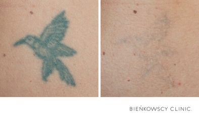 Usuwanie tatuażu - Bieńkowscy Clinic®