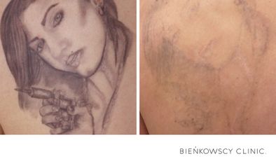 Usuwanie tatuażu - Bieńkowscy Clinic®