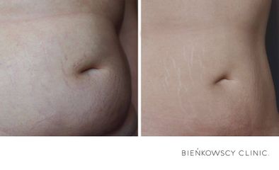 HIFU - Bieńkowscy Clinic®