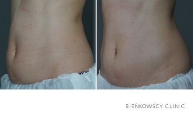 HIFU - Bieńkowscy Clinic®