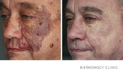 Laserowe usuwanie zmian skórnych - Bieńkowscy Clinic®