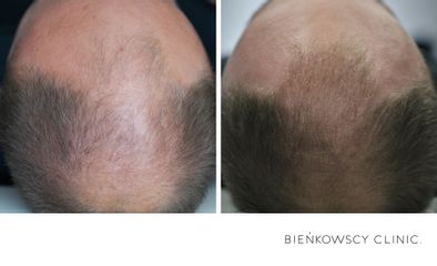 Przeszczep włosów - Bieńkowscy Clinic®
