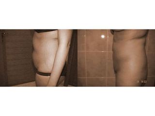 Abdominoplastyka - przed i po