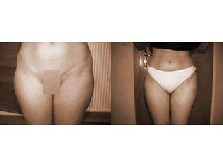 Liposukcja - przed i po