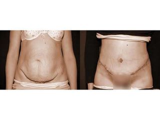 Abdominoplastyka - przed i po
