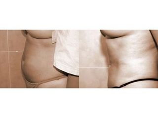 Abdominoplastyka - przed i po