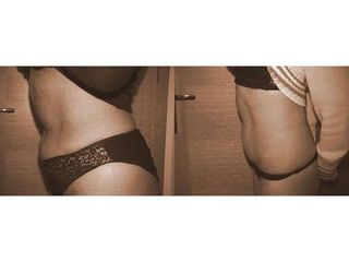 Abdominoplastyka - przed i po