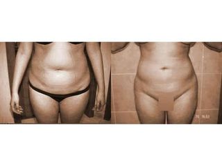 Liposukcja brzucha - przed i po