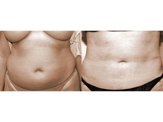 Abdominoplastyka - przed i po