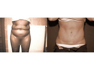 Abdominoplastyka - przed i po