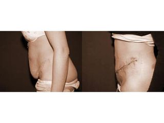 Abdominoplastyka - przed i po